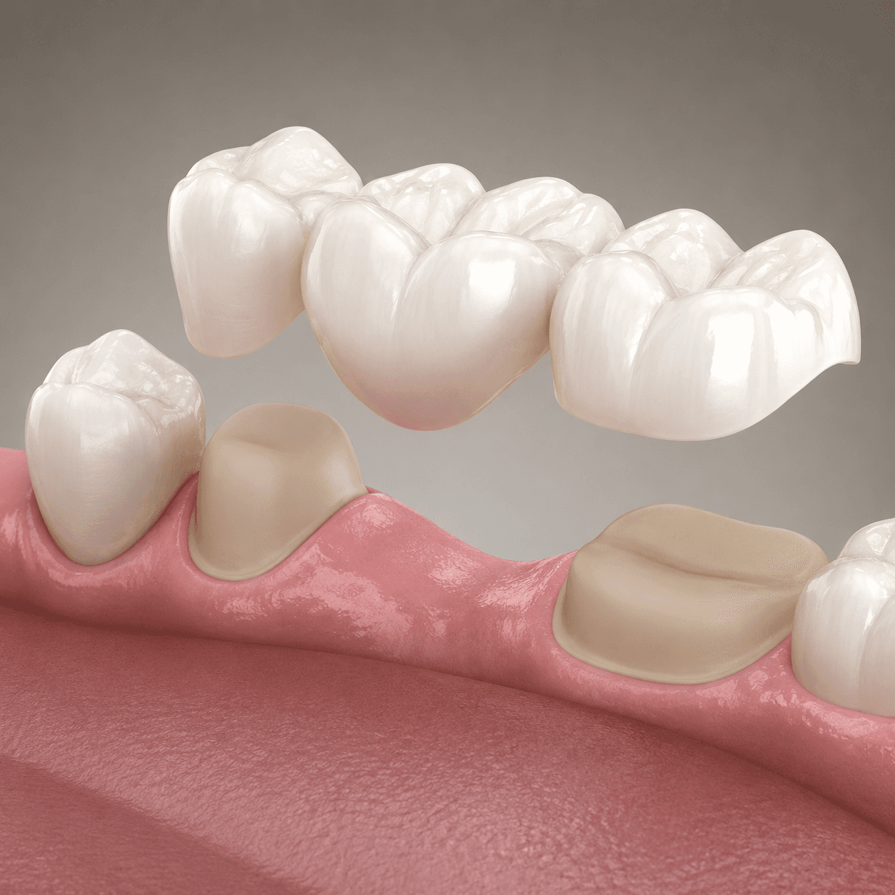 Veneers or crowns: which option fits your smile?