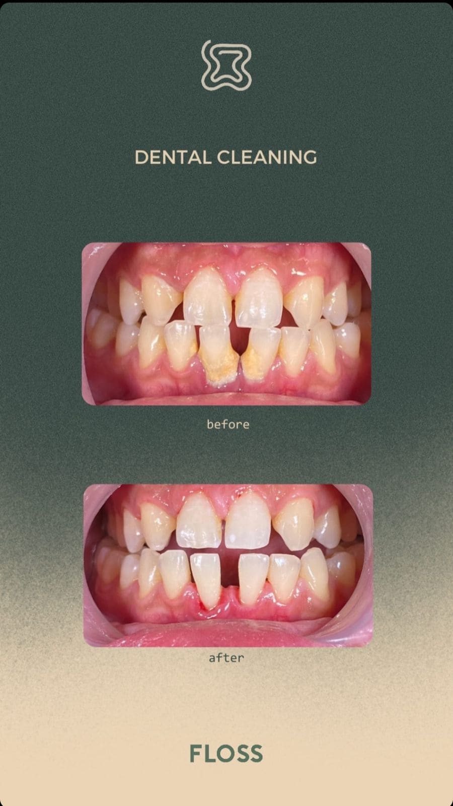 Before after dental cleaning treatment