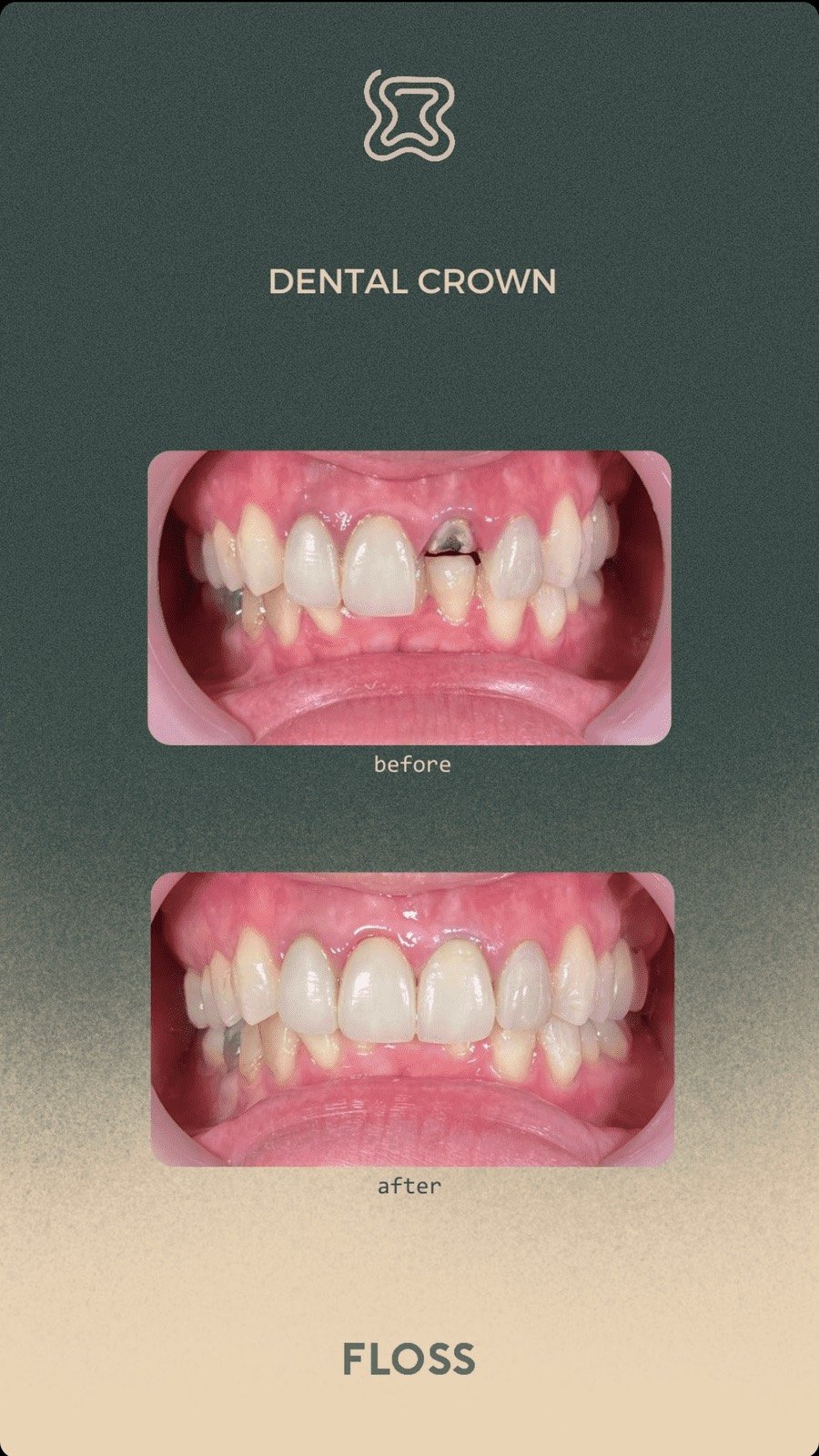 Before after dental crown treatment