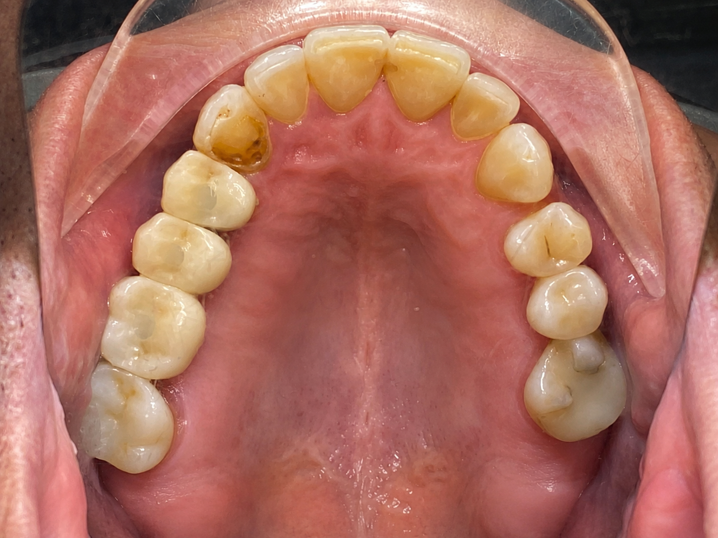 Dental Implants after treatment at FLOSS Dental Studio