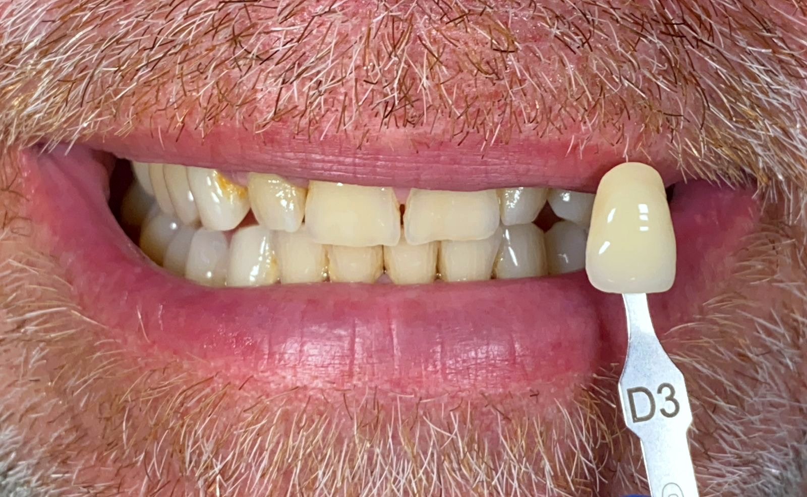 Kondisi sebelum Teeth Whitening di FLOSS Dental Studio
