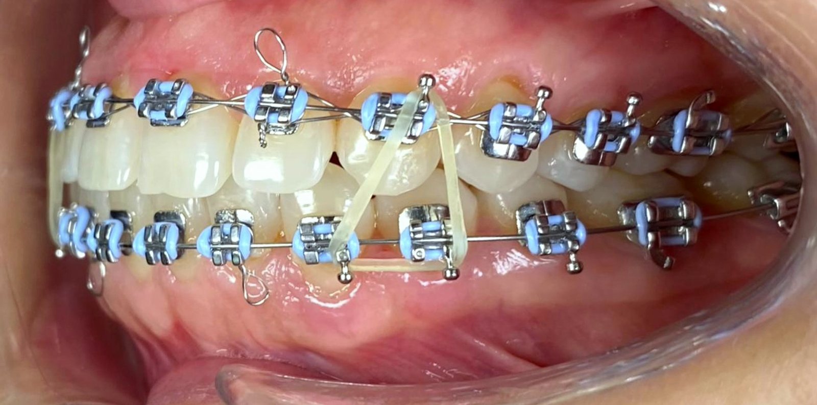 Braces at FLOSS Dental Studio