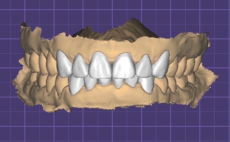 Smile makeover planning at FLOSS Dental Studio